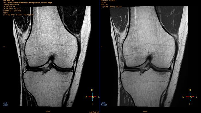 echo accumulation thumbnail