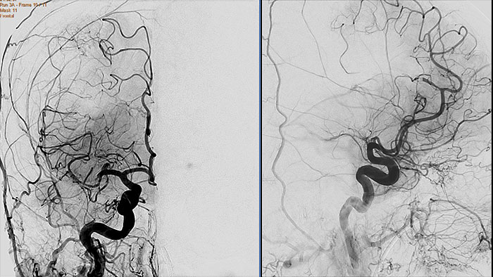 vascular processing thumbnail