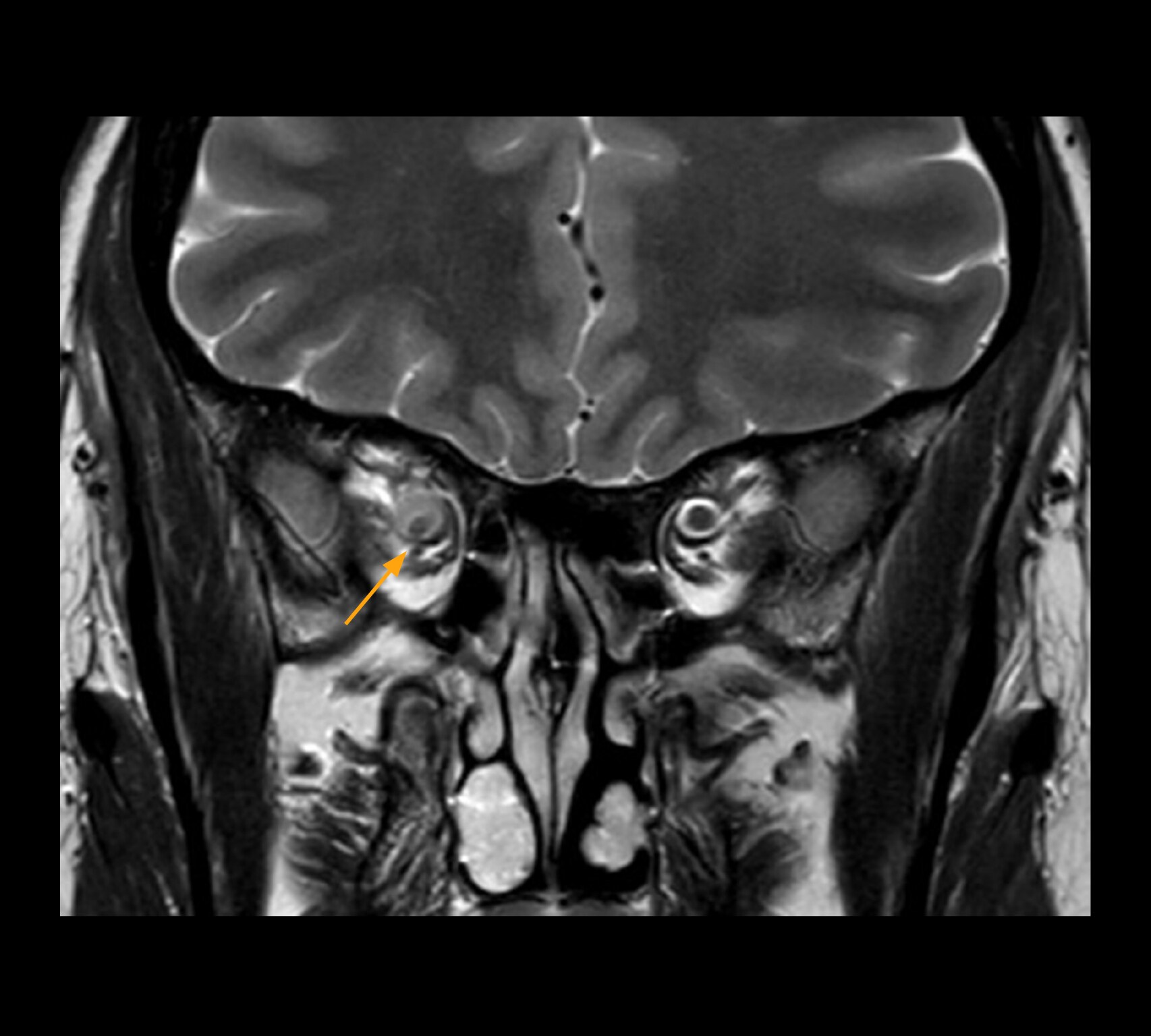 Optic nerve mri two