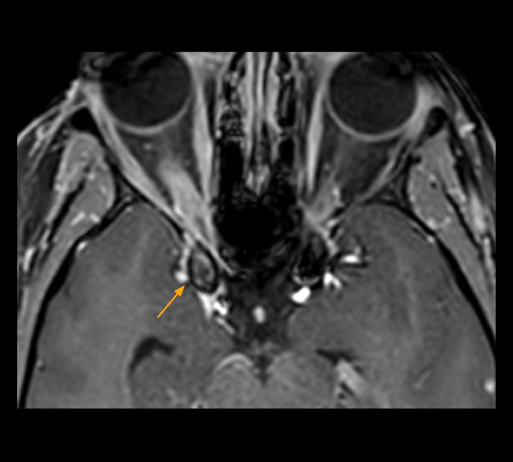 Optic nerve mri three