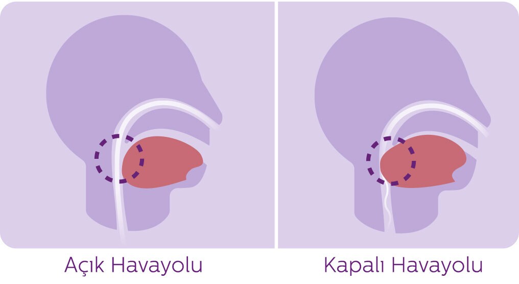 slee_ apnea_diagram