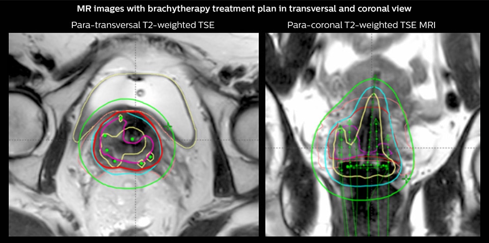 MR images with brachytherapy treatment plan in transversal and coronal view