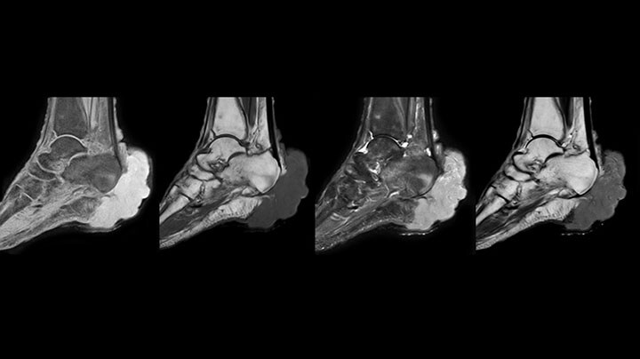 ankle MRI