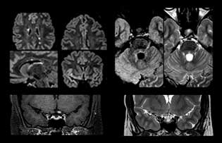 Multiple sclerosis with acute optic neuritis