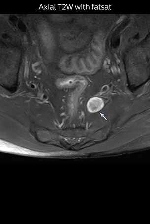 Axial T2W with fatsat