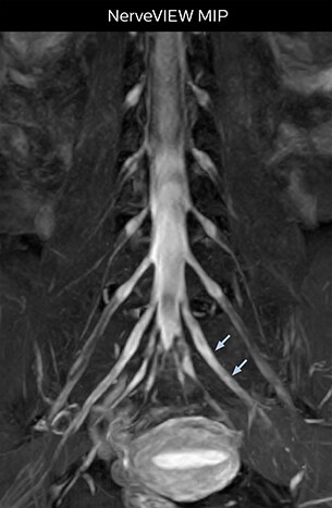 NerveVIEW MIP