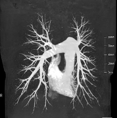 Pulmonary Artery CTA