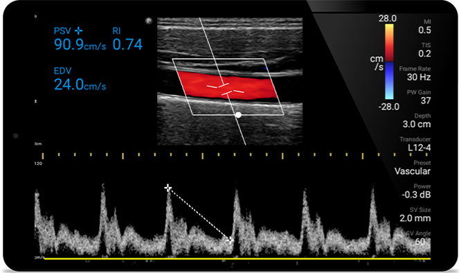 Ultrasound image early detection